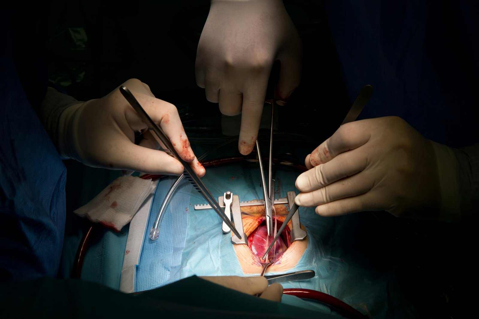 Transplant